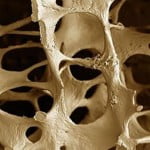 Osteoporosis: la enfermedad de las mujeres después de los 35 @ensaludmujer