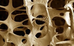 Read more about the article Osteoporosis: la enfermedad de las mujeres después de los 35 @ensaludmujer