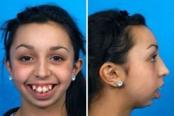 Read more about the article ¡No podrás creer lo cambiada que quedó esta joven después de operarse la mandíbula!