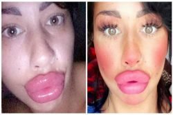 Read more about the article Ella seguirá gastando miles de dólares porque dice que sus labios son pequeños
