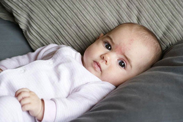 Read more about the article ¿Hay una mancha roja en la frente de tu bebé? Te explicamos qué es y cómo manejarlo